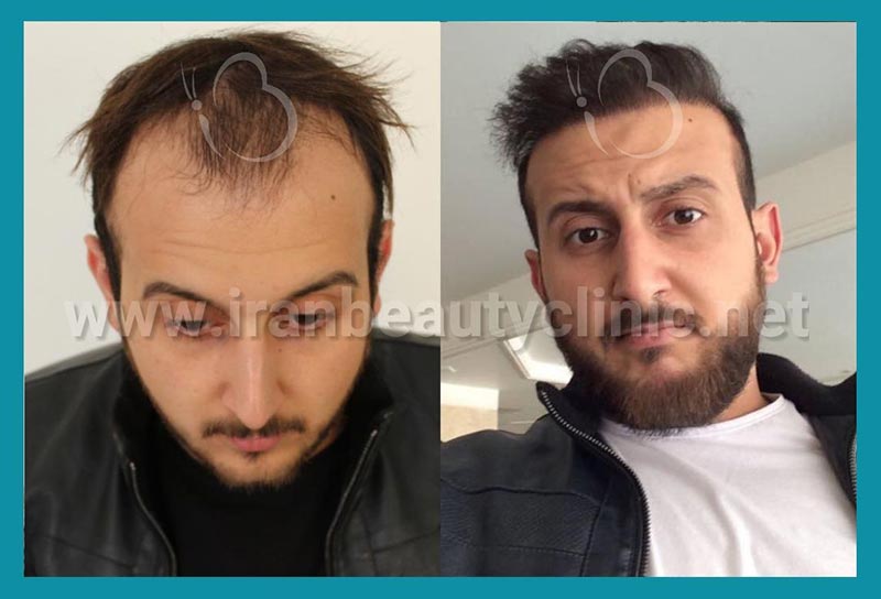 چه سنی برای کاشت مو مناسب است؟ 2 چه کسی برای کاشت مو مناسب است؟