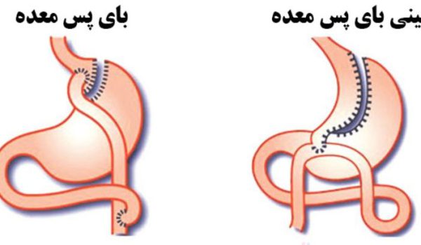 هزینه عمل مینی بای پس معده توسط جراح چاقی 1 هزینه عمل مینی بای پس معده توسط جراح چاقی