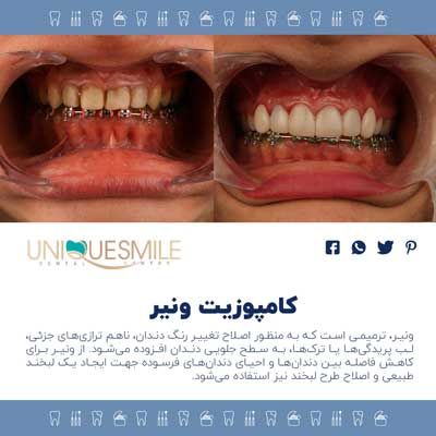کامپوزیت یا لمینت دندان کدام را انتخاب کنیم؟ 2 تفاوتها و شباهتهای لمینت و کامپوزیت دندان
